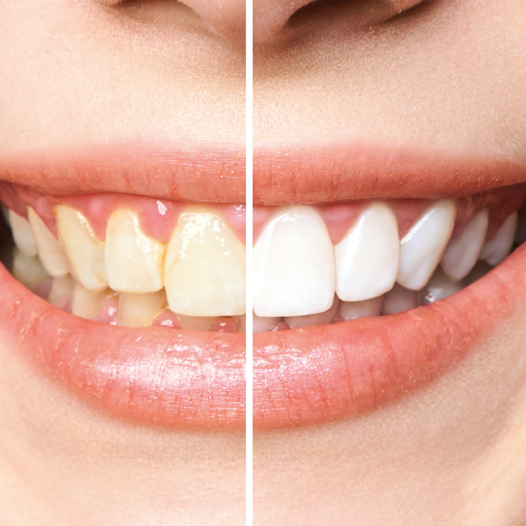 Mitos y verdades sobre el blanqueamiento dental
